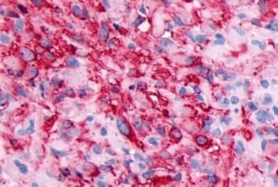 Immunohistochemistry: GPR133 Antibody [NBP3-14348] - Immunohistochemistry of brain, glioblastoma,
